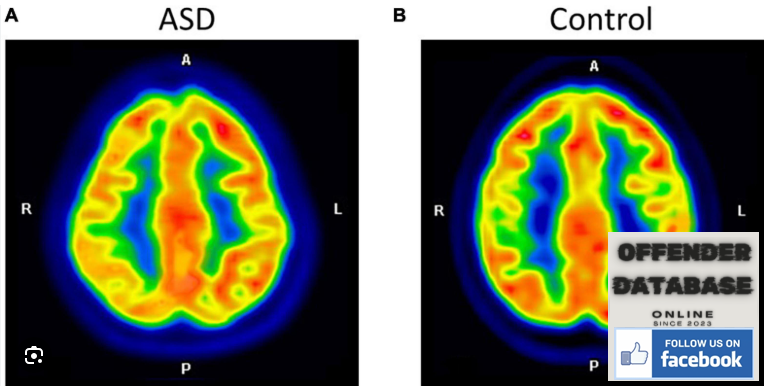 ASD BRAIN IS NOT THE SAME AS NON-ASD